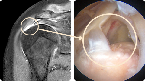 회전근개파열 수술전